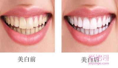 牙齿能洗白吗？